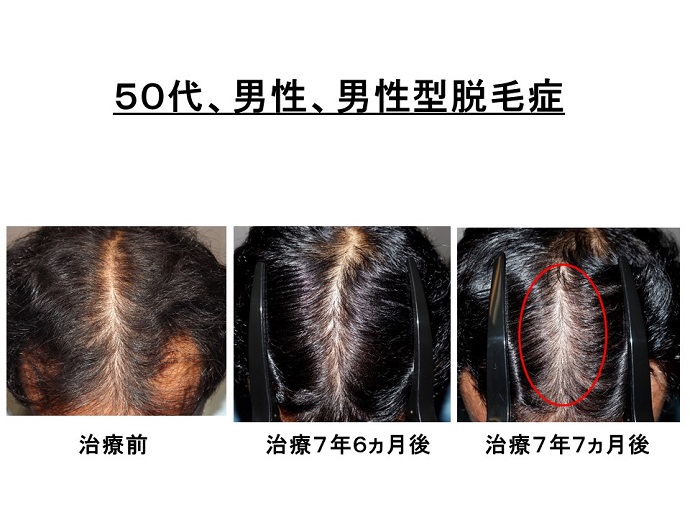 円形脱毛症　病院